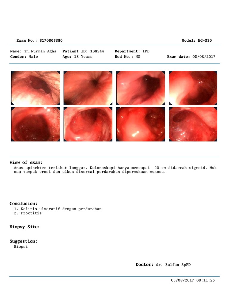 Kolitis Ulseratif dan Proctitis Diagnosis | PDF