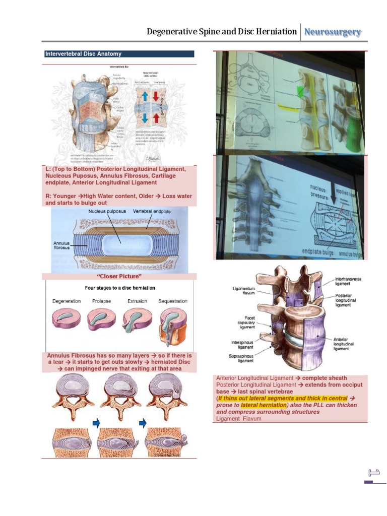 Osteophyte Formation in Disc Degeneration | PDF | Vertebral Column ...