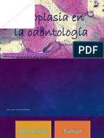 Neoplasia en La Odontología 