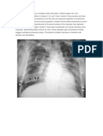 Cardiogenic Pulmonary Edema Seen on Chest X-Ray