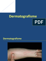 Dermatografism