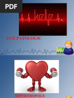 Ecg Patologic