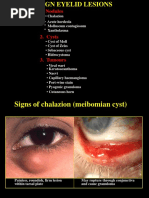 Nodules: - Chalazion - Acute Hordeola