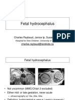 Fetal Hydrocephalus: Charles Raybaud, Janice Ip, Susan Blaser Charles - Raybaud@sickkids - Ca