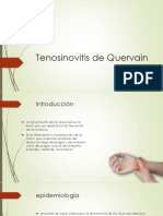 Tenosinovitis de Quervain