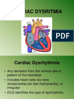 Cardiac Dysritmia