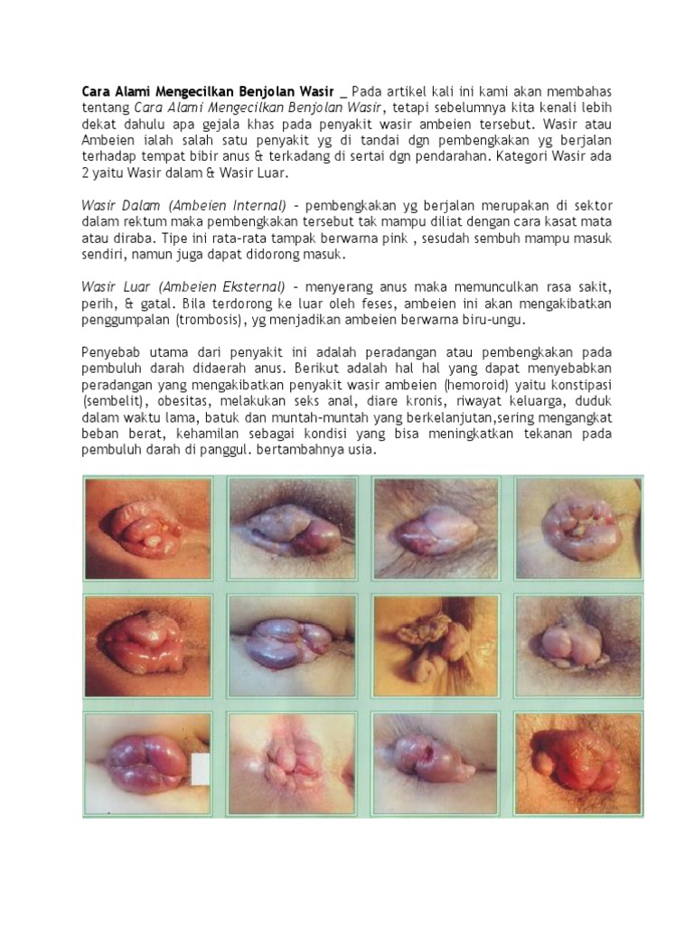 Cara Alami Mengecilkan Benjolan Wasir Pdf