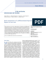 Metástasis Cerebral de Carcinoma Diferenciado de Tiroides