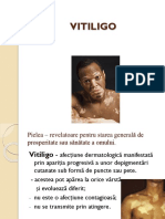 Vitiligo