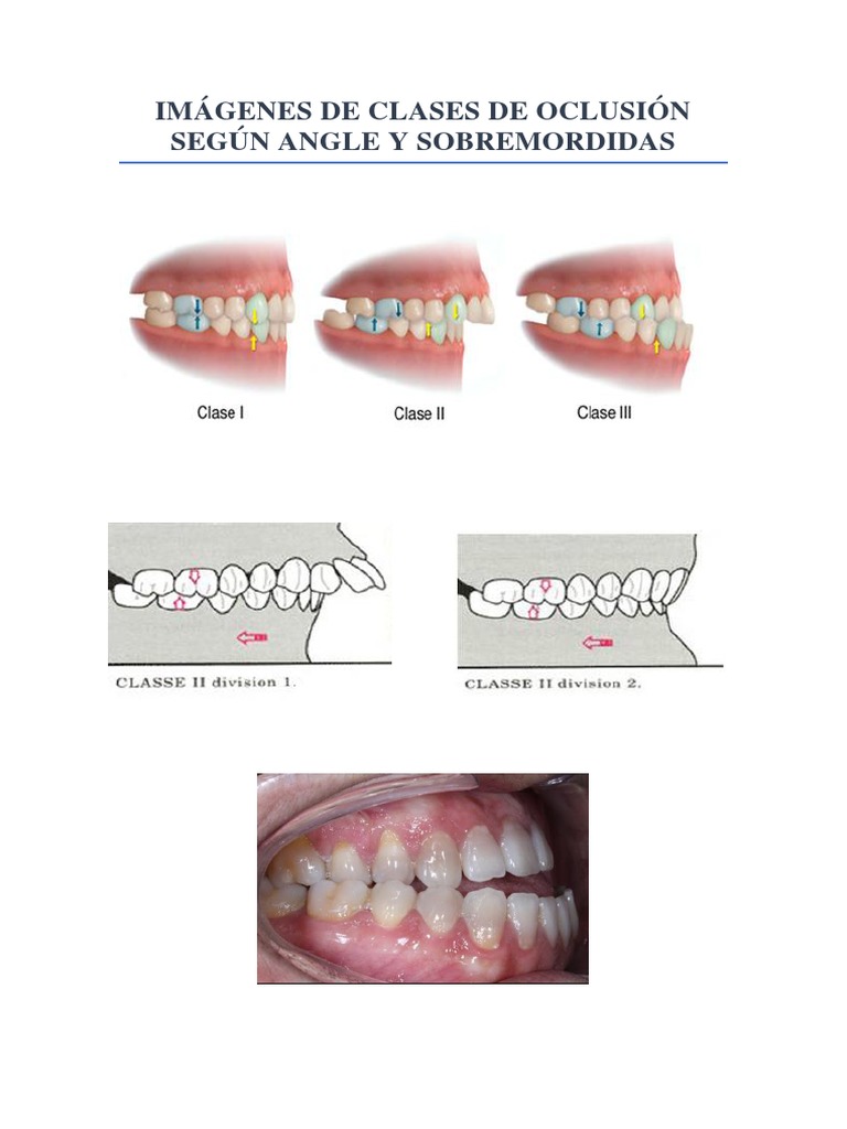 Clases de Oclusión Dental según Angle | PDF