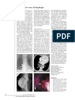 Caso Disfagia PDF