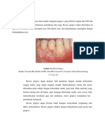 Resesi Gingiva