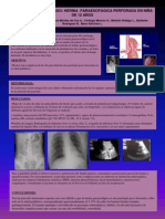 Hernia Paraesofágica Perforada en Niña de 12 Años