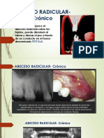 Absceso Radicular Crónico