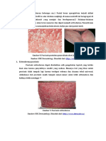 Eritroderma Psoriatic