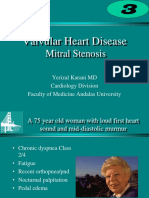 Valvular Heart Disease: Mitral Stenosis