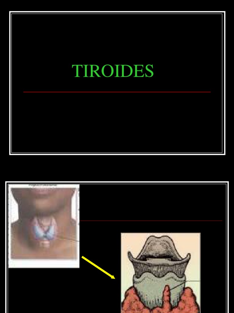 Tiroides Y Embarazoppt Tiroides Hipertiroidismo