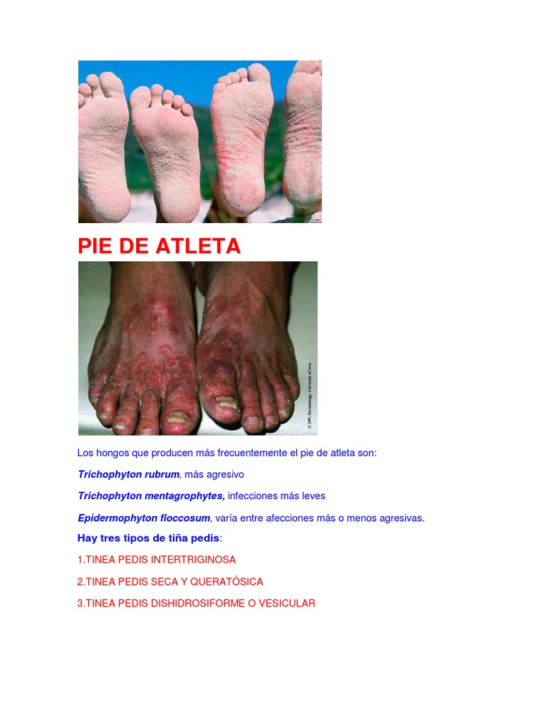 Pie de Atleta PDF Hongo Algas