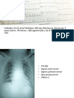 Calibration 10 MV, Atrial Fibrillation, QRS Rate 150x/minute, Normal Axis, P Waves Hard To, PR Interval - , QRS Segment 0,06 S, No ST-T Change, No LVH, No RVH