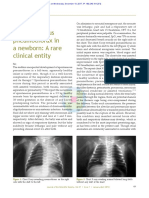 Management of Spontaneous Pneumothorax in A Newborn: A Rare Clinical Entity