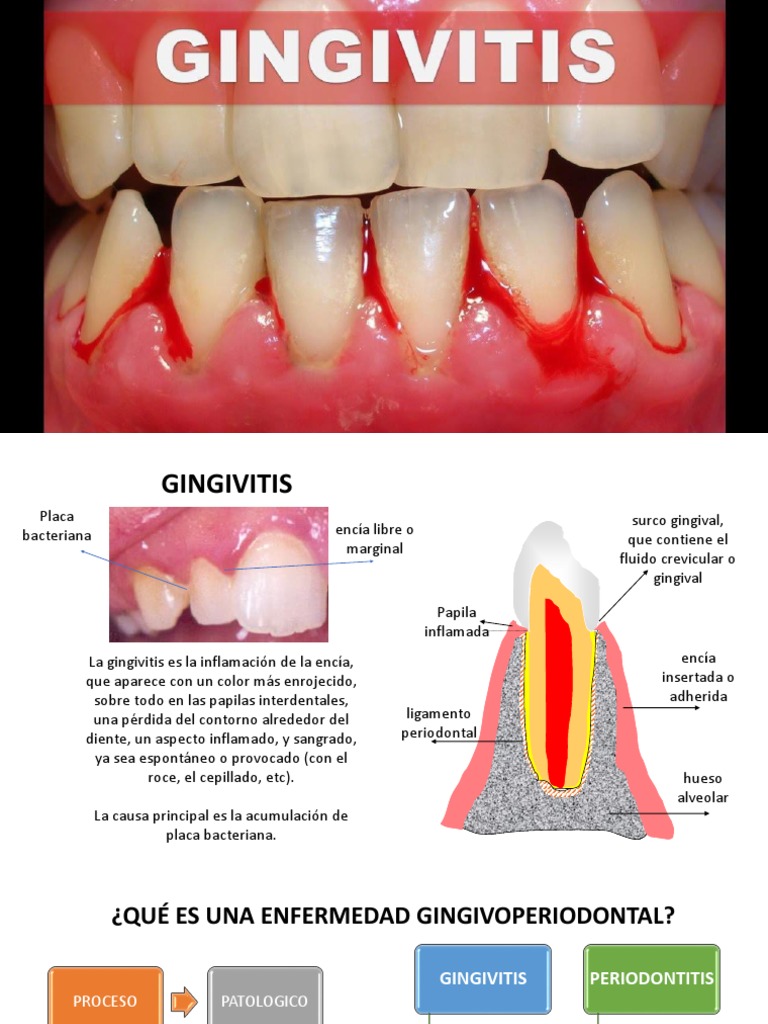 Gingivitis Ramas de Odontología Enfermedades y trastornos
