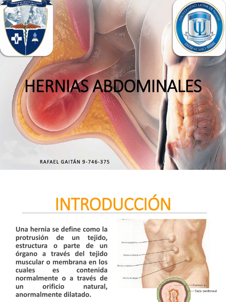 Hernias Abdominales Terminada | PDF | Abdomen | Peritoneo