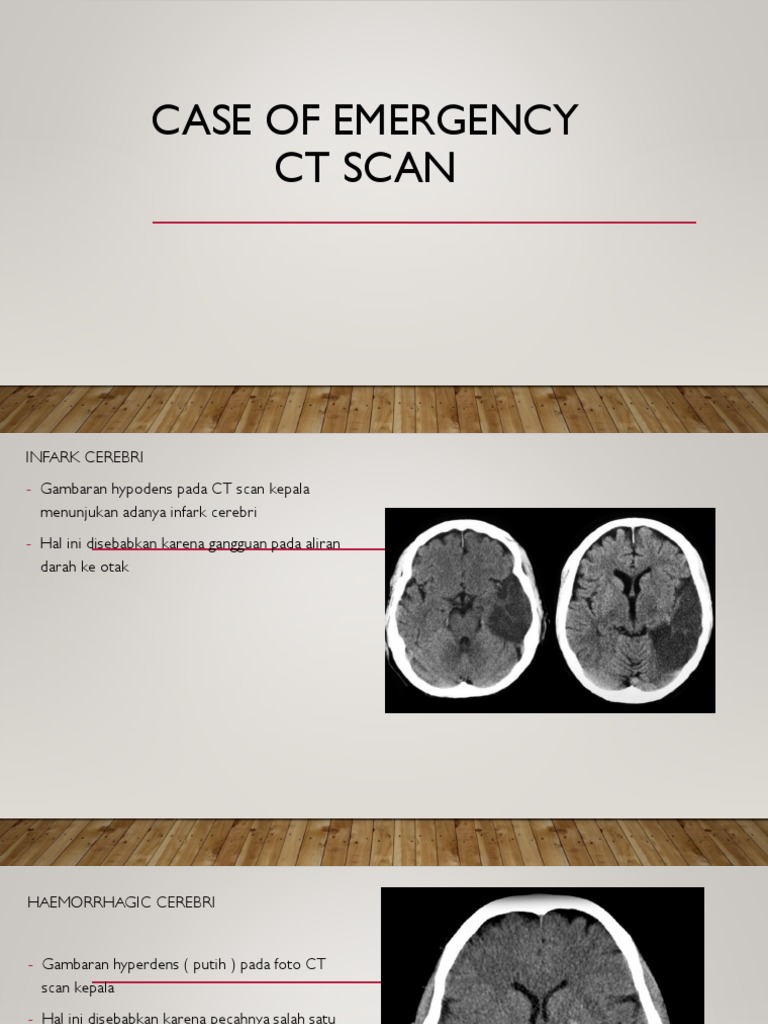 Gambaran CT Scan Infark Cerebri | PDF