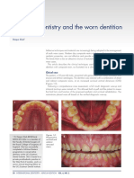 worn dentition and direct & indirect composite restoration.pdf