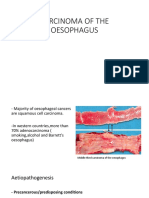 Carcinoma of the Oesophagus: Types, Causes, Spread and Presentation