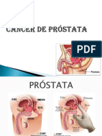Cáncer de Próstata - Diapositiva