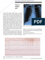 Tuberculous Brain Abscess in Adolescent with Complex CHD