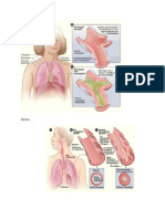 bronquitis asmatica