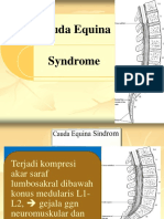 Cauda Equina Sindrome