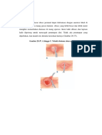 Abses Perianal-Hemoroid