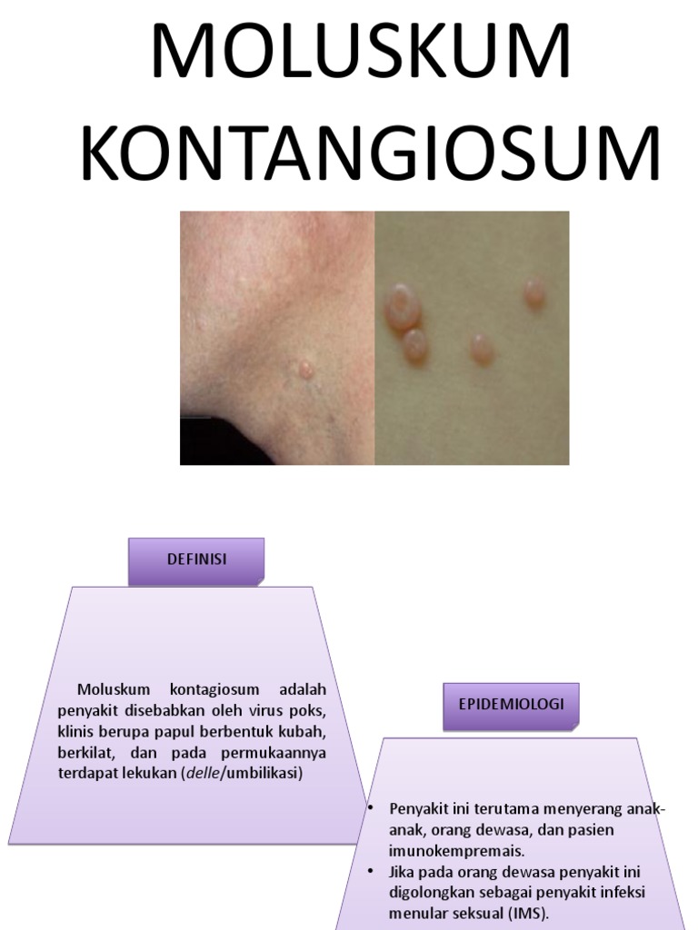Moluskum Kontangiosum | PDF