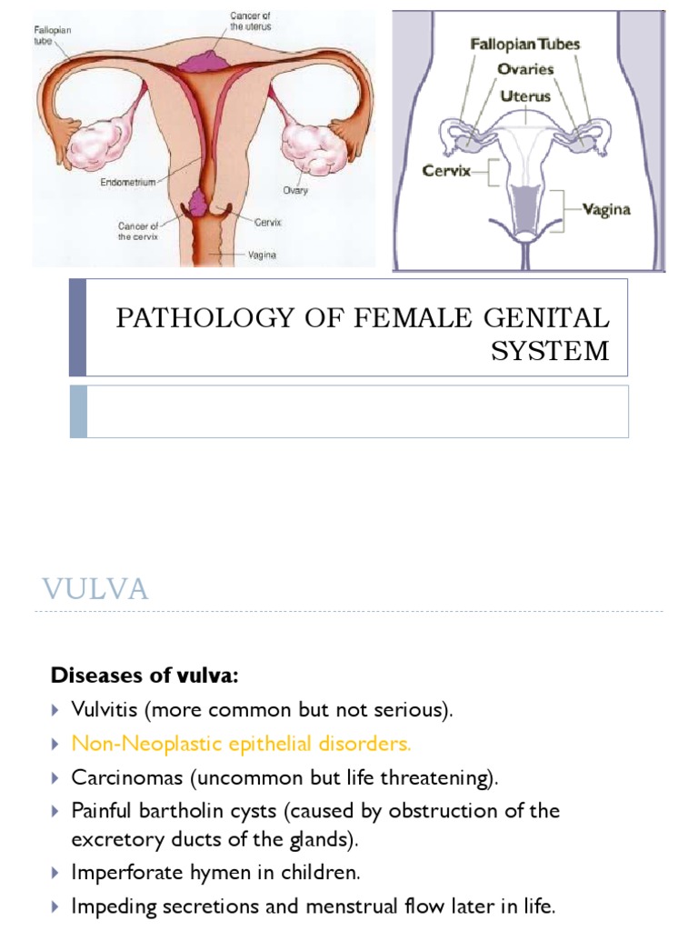 Tumor of Female Genital System Cervical Cancer Ovarian Cancer