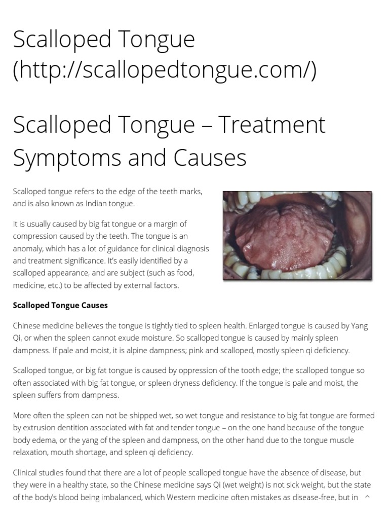 Scalloped Tongue Treatment Symptoms and Causes Scalloped Tongue