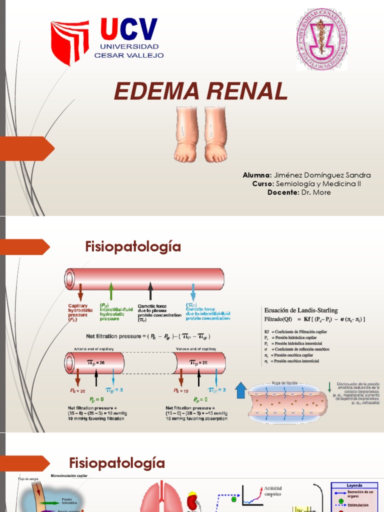 Edema Renal PDF Edema Medicina Interna