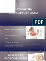 Nevralgia Glosofaringiana