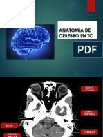 Tomografia Cerebral