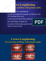 Crown Lengthening: (To Overcome Problems With Gummy Smile)