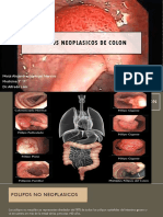 Polipos Neoplasicos de Colon 