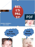 Bells Palsy