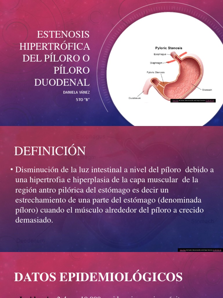Estenosis Pilórica PDF Estómago Especialidades Medicas