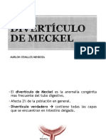 INTESTINO DELGADO: Divertículo de Meckel + Isquemia Mesentérica