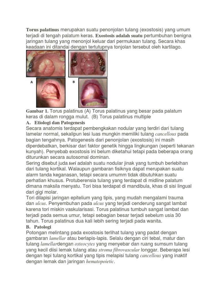Torus Palatinus: Penyebab dan Penanganan | PDF | Kajian Bahasa Asing ...