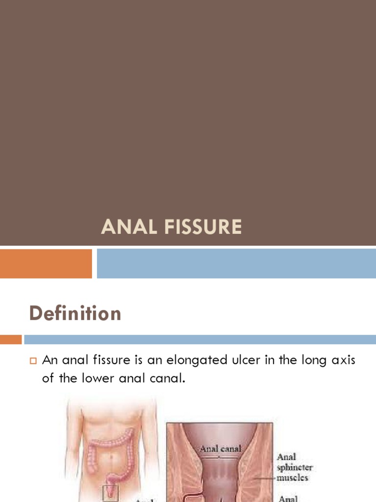Anal Fissure | PDF | Rectum | Medical Specialties