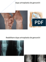 Reabilitare Dupa Artroplastia de Genunchi