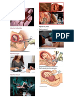 Tipos de Aborto