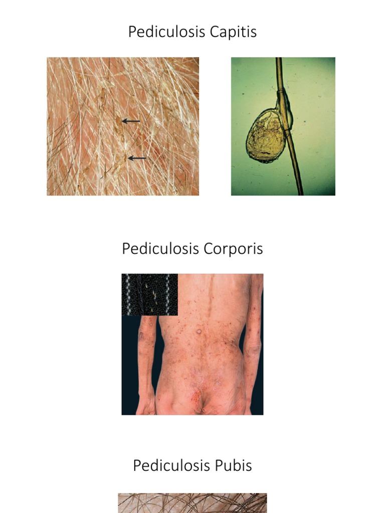 Understanding Skin Parasites and Scabies | PDF